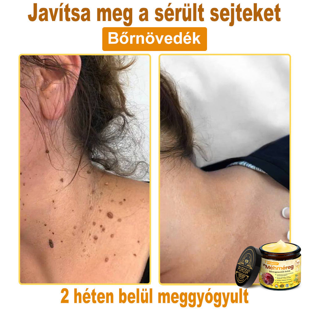 🍋PUROSA® Méhméreg Bőrmegújító Krém|✅Teljes körű megoldás a makacs bőrproblémák, például az öregedés, ekcéma, hegek és pikkelysömör ellen