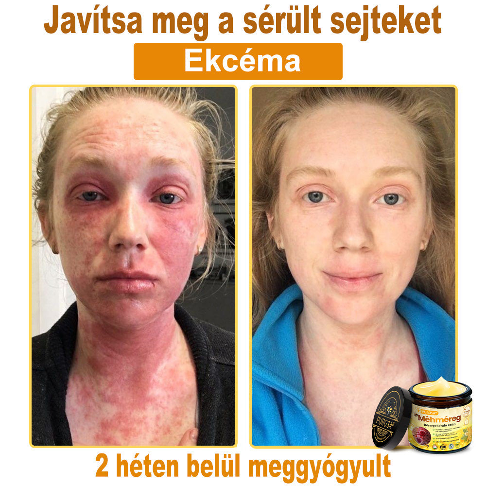 🍋PUROSA® Méhméreg Bőrmegújító Krém｜✅Teljes körű megoldás a makacs bőrproblémák, például az öregedés, ekcéma, hegek és pikkelysömör ellen